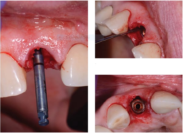 Left: BioHorizons 2.0 drill; Top Right: Perio Probe measuring distance from CEJ; Bottom Right: Final position of implant