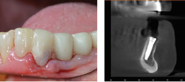 Left: Figure 18: Final temporary; Right: Figure 19: Final CBCT before placing abutment