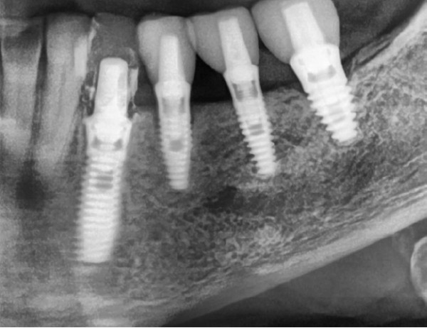 Figure 20: Final implant with temporary crown