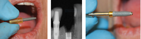 Left: Figure 10: ENGAGE implant; Center: Figure 11: Position of ENGAGE implant; Right: Figure 12: 4.0 x 14 TSI Implant