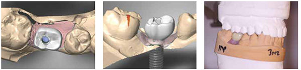 Figure 13: Computer-aided design of the restoration (occlusal view); Figure 14: Computer-aided design of the restoration (buccal view); Figure 15: Restoration returned from the lab (buccal view on articulated model)