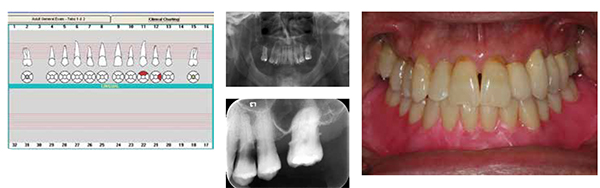Figures 2A-2C: 2A.Clinical charting of pretreatment dental condition. 2B. Preoperative panoramic X-ray. 2C. eriapical X-ray of tooth No. 12 demonstrating non-restorable carious lesion; Figure 3: Frontal view of the waxed denture teeth try-in