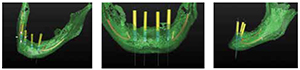 Figures 5A-5C: 5A. Oblique view of the proposed implant position within the mandible as viewed in the segmented and formatted image using Facilitate™ software (Dentsply Implants). 5B. Frontal view of the proposed implant positions using Facilitate software. 5C. A lateral left side view of the proposed implant positions demonstrating the distal angulation of the terminal implants