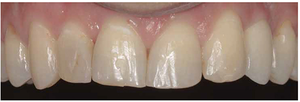 Figure 11: Two-year follow-up. The imperceptible restoration despite malpositioned UL3 in the UL2 space