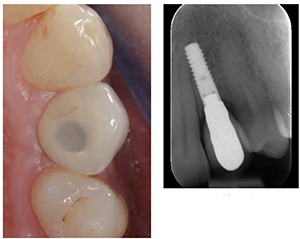 Figure 12: Definitive screw-retained restoration — the contours of which should snugly fit the subgingival emergence. The restoration should be neither over- nor under-contoured; Figure 13: Radiograph at 2 years, demonstrating well maintained bone levels