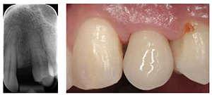 Figure 3: Post-orthodontic radiograph demonstrating limited interradicular space; Figure 4: A screw-retained provisional restoration is inserted for soft tissue sculpting. Note the discrepancy in the gingival height between the provisional restoration and the adjacent teeth