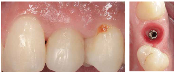 Figure 5: Soft tissue sculpting is carried out over a few visits by modifying the provisional crown; Figure 6: The emergence of the restoration mimics a natural tooth, and the implant is ready 