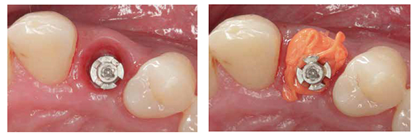 Figure 7: The shape of the impression coping does not correspond to the shape of the subgingival emergence. To facilitate the technician, impression coping should be customized; Figure 8: A hard-setting silicone bite registration material (Stone Bite®, Dreve Dentamid GmbH) is used directly in the mouth to capture the detail of the subgingival emergence