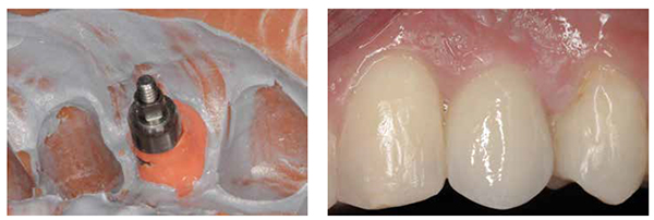 Figure 9: Customized impression coping is incorporated within the impression, and an ideal working cast can be created; Figure 10: Postoperative view. The final restoration, fulfilling all the pink and white esthetic criteria