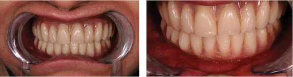 (L to r) Figure 12: Upper and lower temporary acrylic fixed bridges Figure 13: More space and flexibility in the lower labial vestibular region