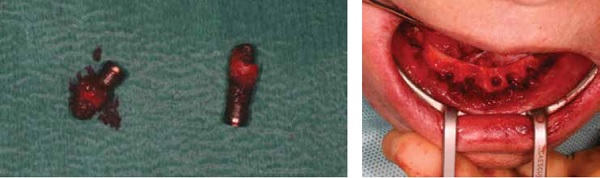 (L to r) Figure 9: Two fixtures removed using trephine as osseointegration made it impossible to unscrew the fixtures Figure 10: Mandible post removal of all seven fixtures