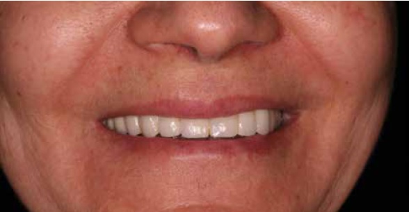 Figure 27: Smiling with final restorations in situ