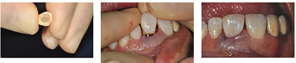 Figure 16: Approximately the shape around the immediate temporary abutment; Figure 17: Enamel shell tried over abutment; Figure 18: Enamel shell filled with Luxatemp and seated over abutment