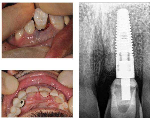 (counterclockwise) Figure 27: Seating on abutment with no need for cement; Figure 28: Palatal surface eased to eliminate contact in centric and protrusive excursions; Figure 29: PA showing full seating of UL1 crown on abutment