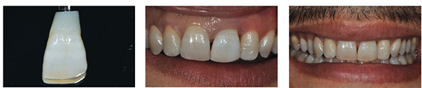 Figure 33: Enamel shell bonded to definitive IPS e.max hybrid abutment; Figure 34: Immediately after fit. Note dehydration causing value to be too high; Figure 35: Final review at 2 weeks