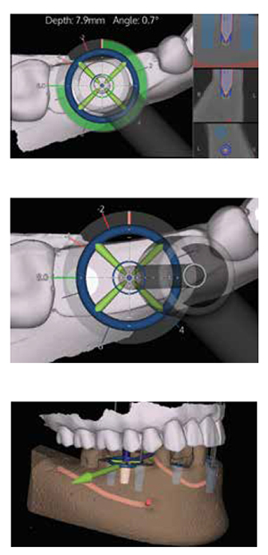 X-Guide live navigation with CBCT cross-sections; X-Guide X-Point Target axial view; X-Guide implant plan with intraoral scan