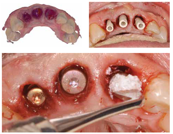 Figures 13A-13C: A. Scan of sockets for soft tissue modeling. B. Scan bodies in place for virtual impression via intraoral scanning. C:. Xenograft (Bio-Oss®, GPNA, Princeton, New Jersey) to fill buccal horizontal defects around the implants that were just inserted