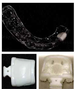 Figures 2A-2C: A. Imaging guide with radiopaque tooth fabricated from diagnostic wax-up. Area in left maxilla removed for placement of an X-Clip. B. X-Clip before placement in water bath. Thermoplast is opaque and hard. C. X-Clip warming in a water bath. Thermoplast is soft when it becomes clear and ready to place intraorally