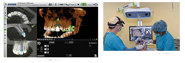 Figure 3: Virtual planning the implant using the XOS software; Figure 4: Surgeon watches the screen during guidance, and first assistant watches patient. The X-Guide stereo cameras, LED lights, and drill pattern tracking array can be seen