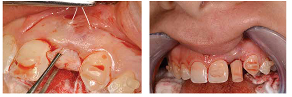 Figure 5: Subepithelial connective tissue graft being cinched into position to bulk out the buccal deficiency for a more natural esthetic relationship to the adjacent root prominences; Figure 6: Prefabricated PEEK provisional abutment placed on the implant for chair side customization