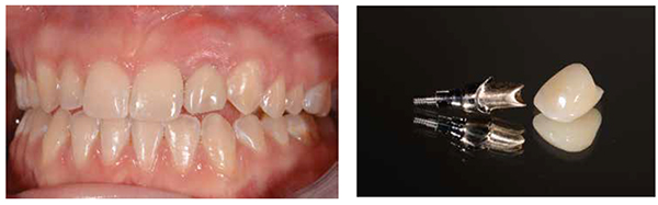 Figure 7: Two weeks post surgery. Peek provisional abutment with customized patient and site specific restoration; Figure 8: Final restoration consisted of a custom gold UCLA abutment and all ceramic lithium disilicate crown. (Kaz RDT Dental Laboratory)