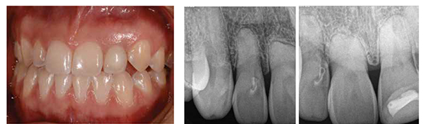 Figure 9: Natural emergence profile, ceramic color matching, and mature soft tissue with ideal root eminence, full papilla, and stippled gingival surface texture. (Kaz RDT Dental Laboratory); Figures 10A-10B: A. Patient presented with thick soft tissue, minimal recession, and a high smile. B. Root blunting with internal resorption teeth Nos. 7, 8, and 9