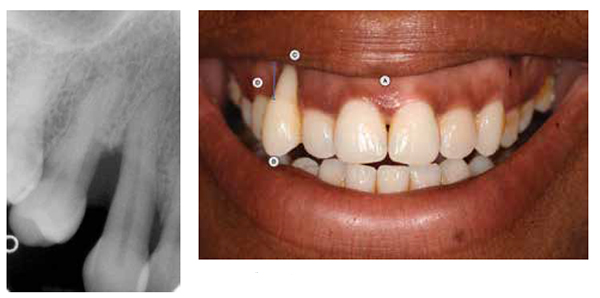 Figure 10: Initial radiograph; Figure 11: There were several key issues to address. A. the very high smile line. B. the UR3 was 5 mm out of the line of the arch. C. A 10 mm recession defect was apparent. D. The UR3 had drifted forward and buccally