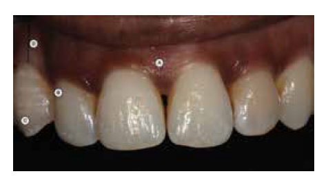 Figure 26: By the final fit, many of the patient’s issues had been addressed. A. High lip line. B. Mesial papilla has been generated. C. UR3 is in line of the arch. D. No 10 mm recession defect
