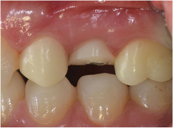 Figure 4: Milled provisional crowns on UL4 and UL6, and customized healing abutment at UL5 placed immediately after implant insertion