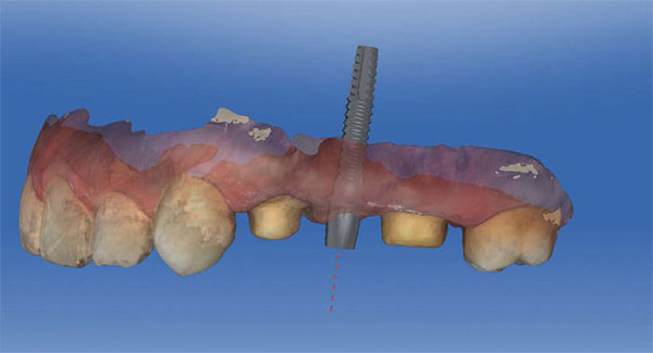 Figure 1B: Digital impression of teeth preparation and implant