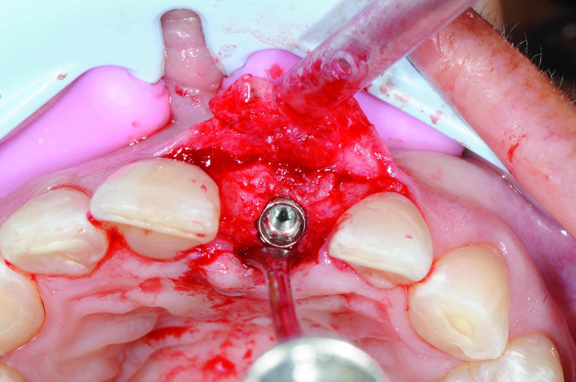 Implant CE Article - Understanding bone augmentation and regeneration