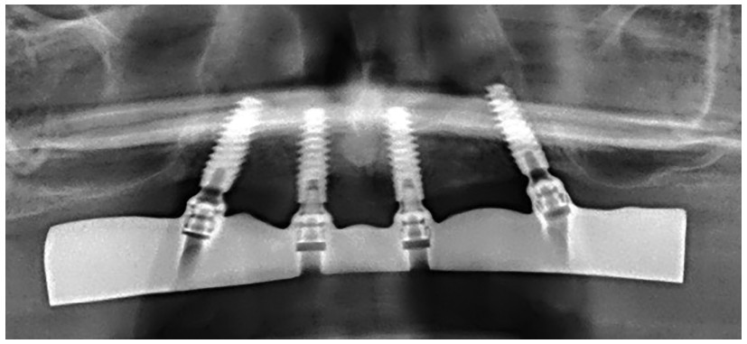 Figure 36: Final control X-ray after fitting bridge