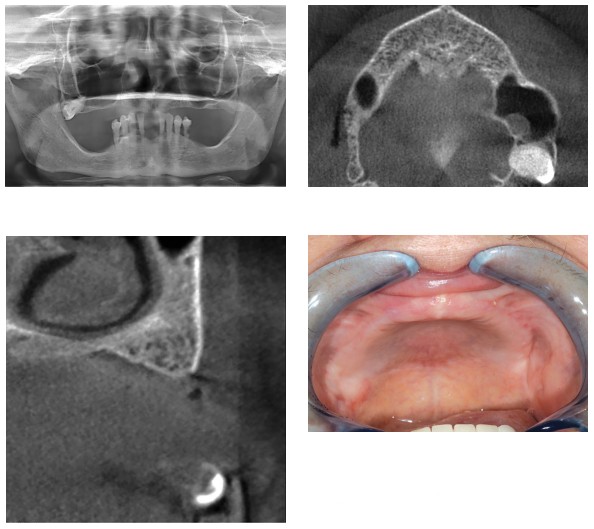 Figure 11 (upper left): Preoperative panoramic radiograph; Figure 12 (upper right): Preoperative CBCT; Figure 13 (lower left): Clinical CBCT; Figure 14 (lower right): The completely edentulous maxilla