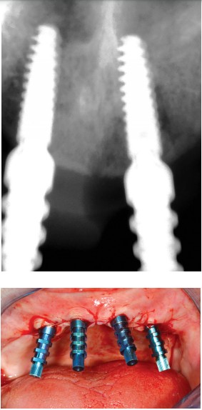 Figures 20A (top) and 20B (bottom): A. A control X-ray was taken to confirm the position of the implants. B. Implants in place