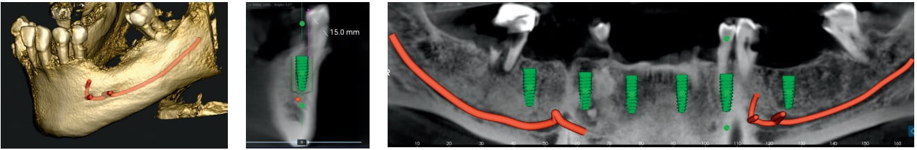 Biohorizons And Cbct Working Together