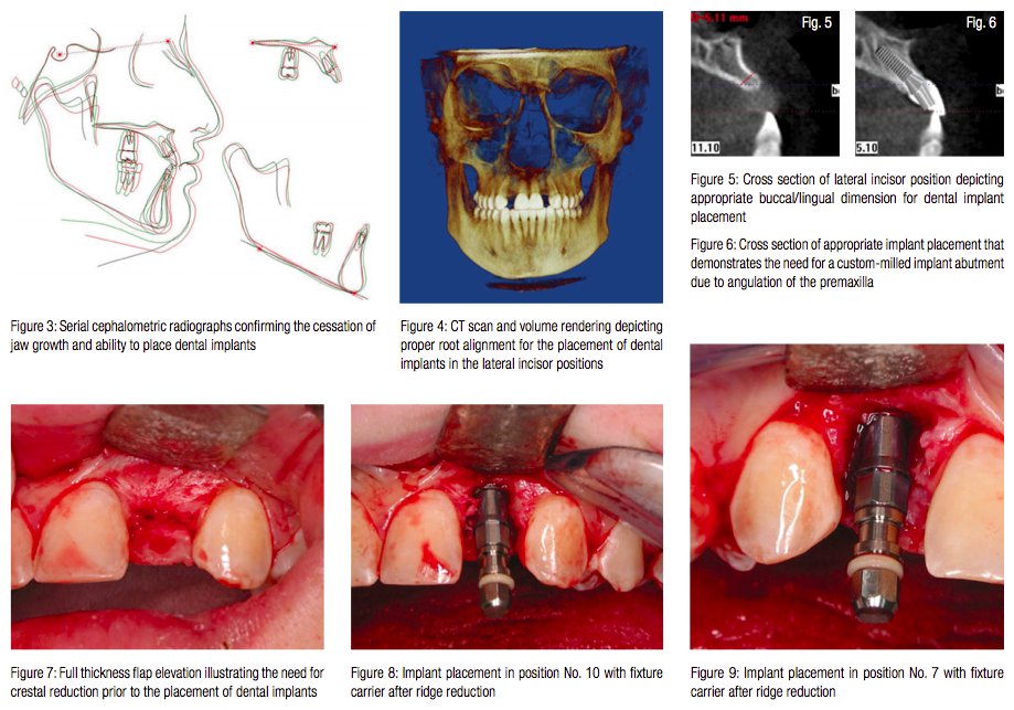 Straumann Roxolid Slactive Implant