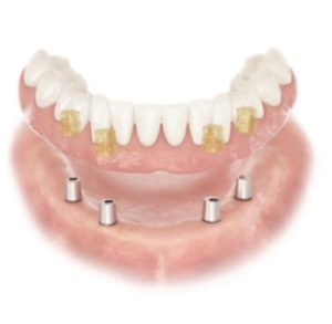 Implantology News - Introducing ATLANTIS Conus concept by DENTSPLY Implants