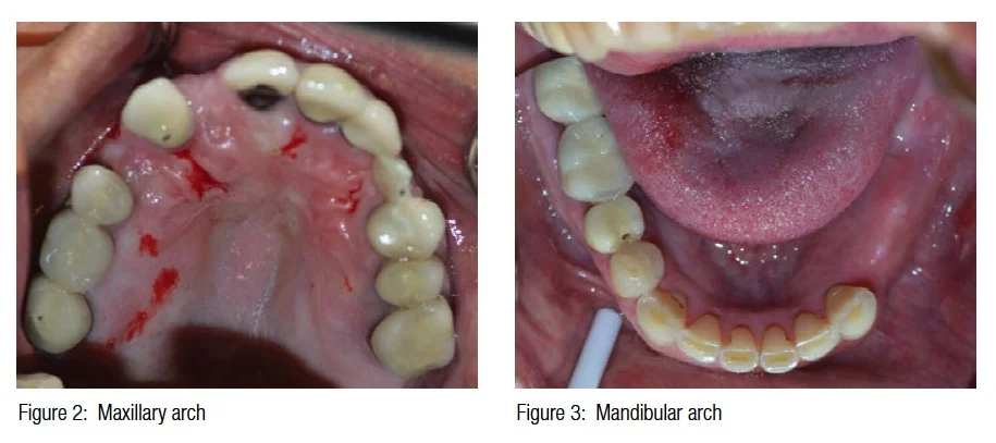figure2-maxillary-arch-figure-3-mandibular-arch
