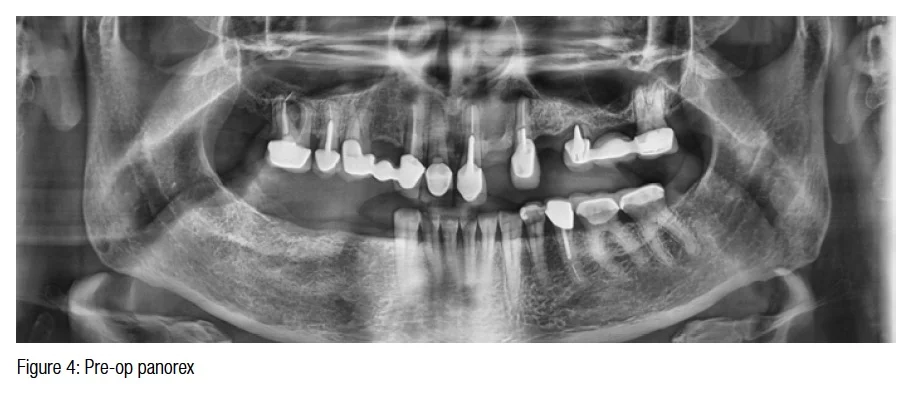 figure4-pre-op-panorex