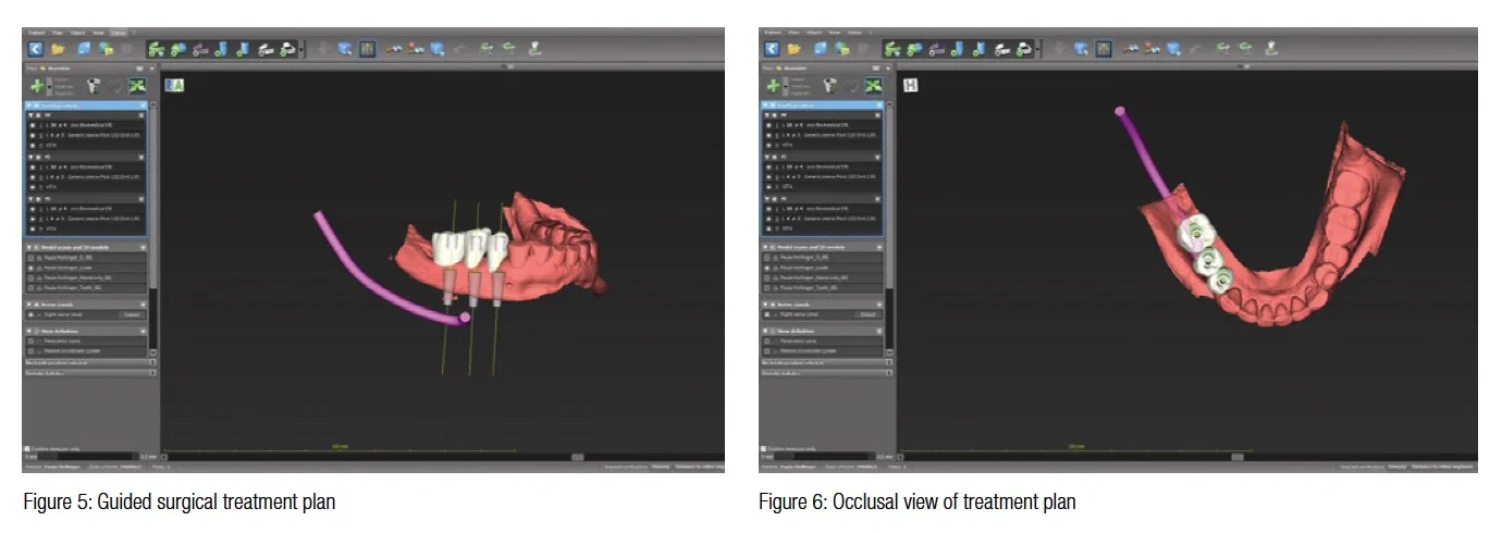 figure5-6-guided-surgical-treatment-plan