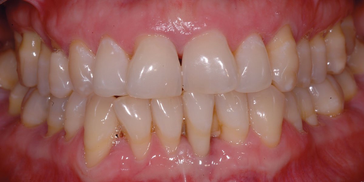 Implant CE Article - Ridge preservation in a case of severe periodontitis