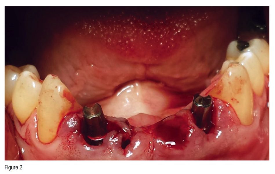 Implantology News Post Extraction Immediate Placement And