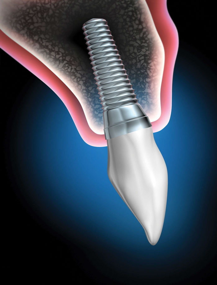 implant-dentist