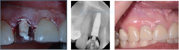 Left: PEEK plastic BioHorizons abutment; Center: Post-op radiograph with temporary; Right: Temporary restoration in place