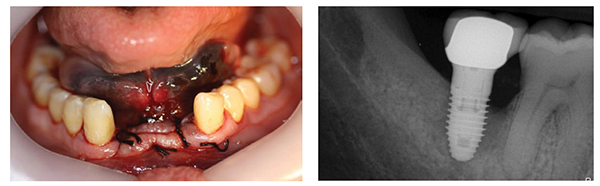 Figure 11 (left): Clinical appearance of patient following moderate floor of mouth hemorrhage after penetration of a dental implant drill through the lingual mandibular plate. Figure 12 (right): A radiolucent border between a dental implant and the alveolar bone is an indication of implant failure.