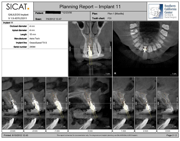 Figure 4: Implant planning software uses the 3D image from a CBCT to evaluate the bony anatomy and plan the ideal sites and positions for dental implant placement
