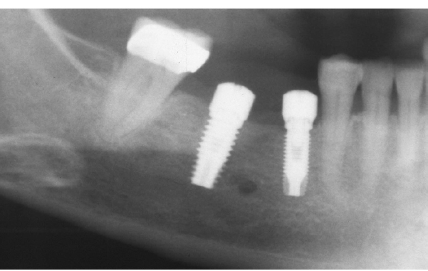 Figure 6: A postoperative panoramic radiograph demonstrates the penetration of a dental implant into the inferior alveolar canal. Planning was based on a panoramic radiograph and placed freehand by an experienced implantologist