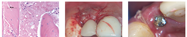 Figure 17: Core sample showing small graft remnants at 3 months, H and E stain (Dr. Mangham); Figure 18: Fitting healing cap and denture; Figure 19: Soft tissue healed after 1 week