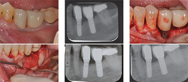 (Left to right): Figure 2: The presence of peri-implant complications on the LL5 implant-supported crown with cryonic periimplant mucosa as well as the presence of BOP and exudate; Figure 3: The presence of peri-implant complications with marginal bone loss; Figure 4: After flap reflection, an infrabony defect on buccal aspect of the implant was noticed; Figure 5: Regenerative therapy was performed using allograft and collagen membrane; Figure 6: Postoperative outcome at three months after surgery. Significant bone fill of the infrabony defect was noticed; Figure 7: Postoperative outcome at six months after surgery. The postoperative crestal bone level remains stable