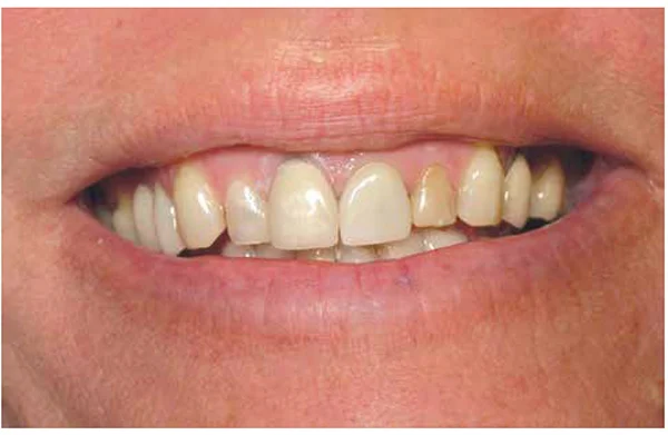 Figure 1: Preoperative condition of the patient, whose post-and-core crown for tooth No. 8 had debonded after years of function and was deemed non-restorable. The patient’s tooth was temporarily cemented to serve the patient until implant treatment could be performed